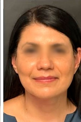 Lifting facial caso 2 — después